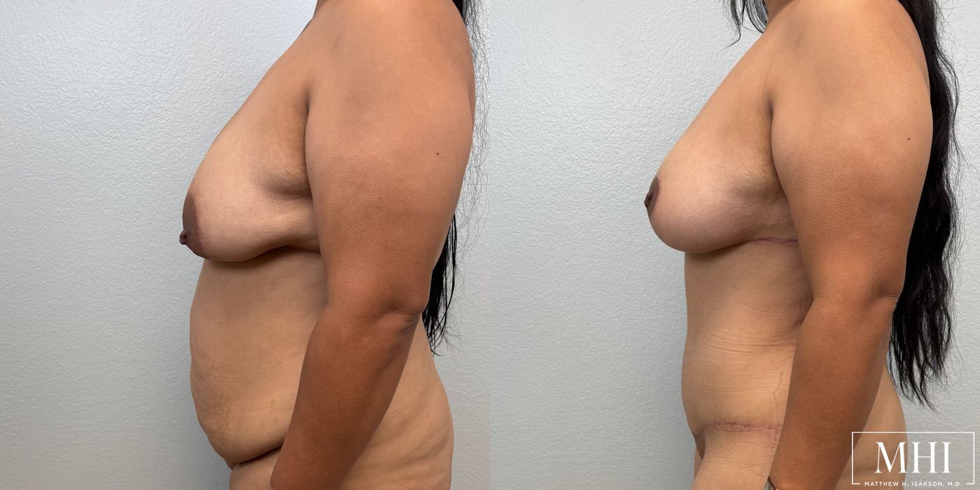 Breast Lift - Case 12150
