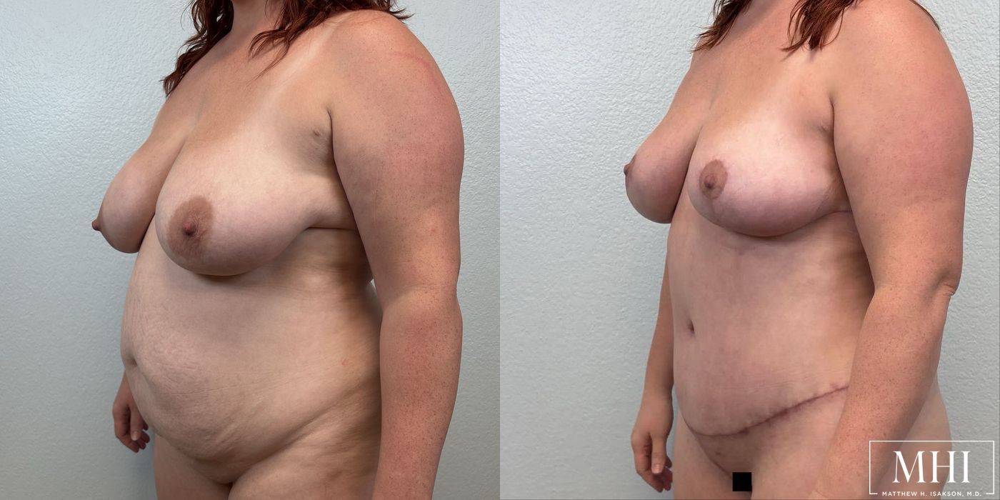 Breast Lift - Thumbnail 2