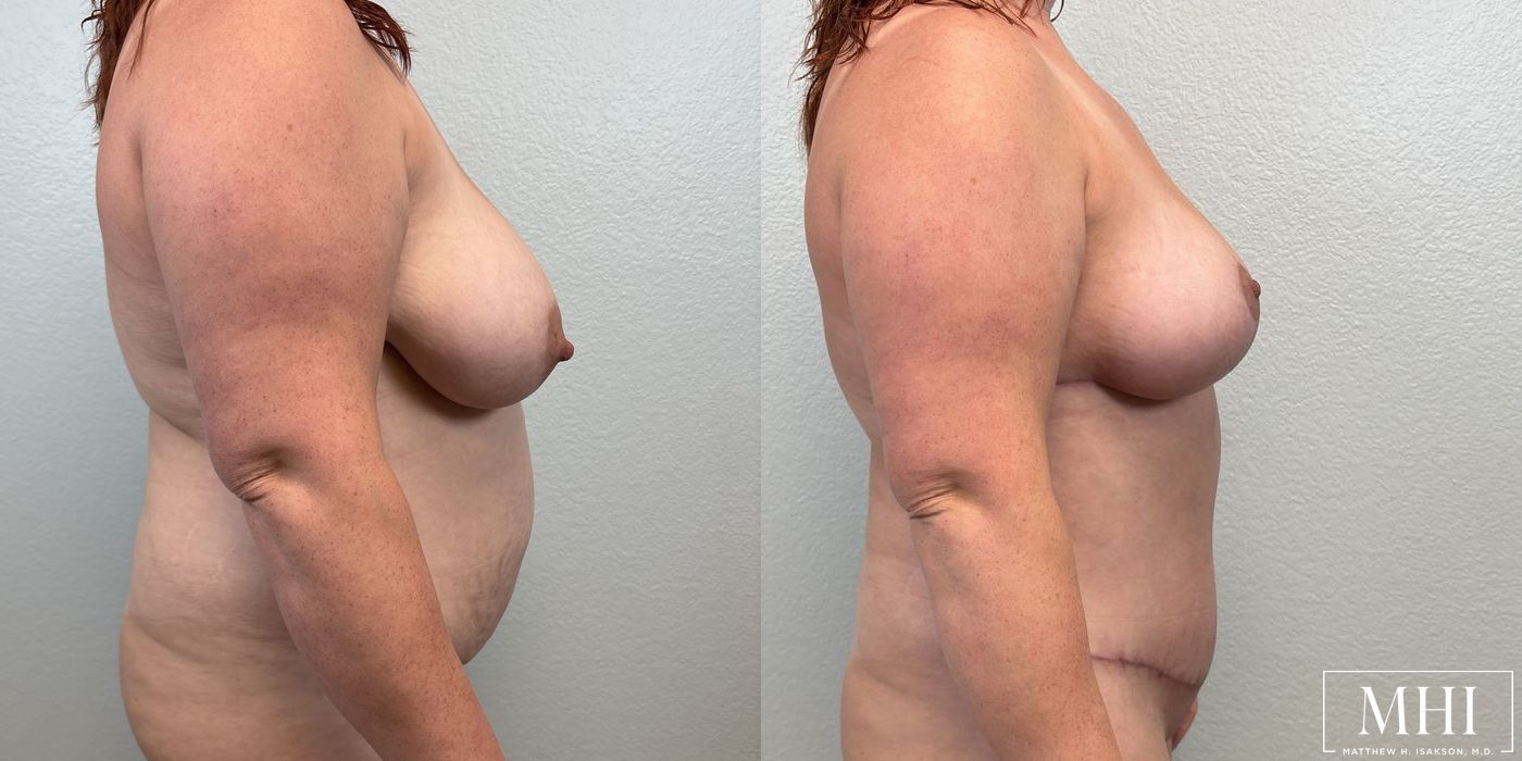 Breast Lift - Thumbnail 5