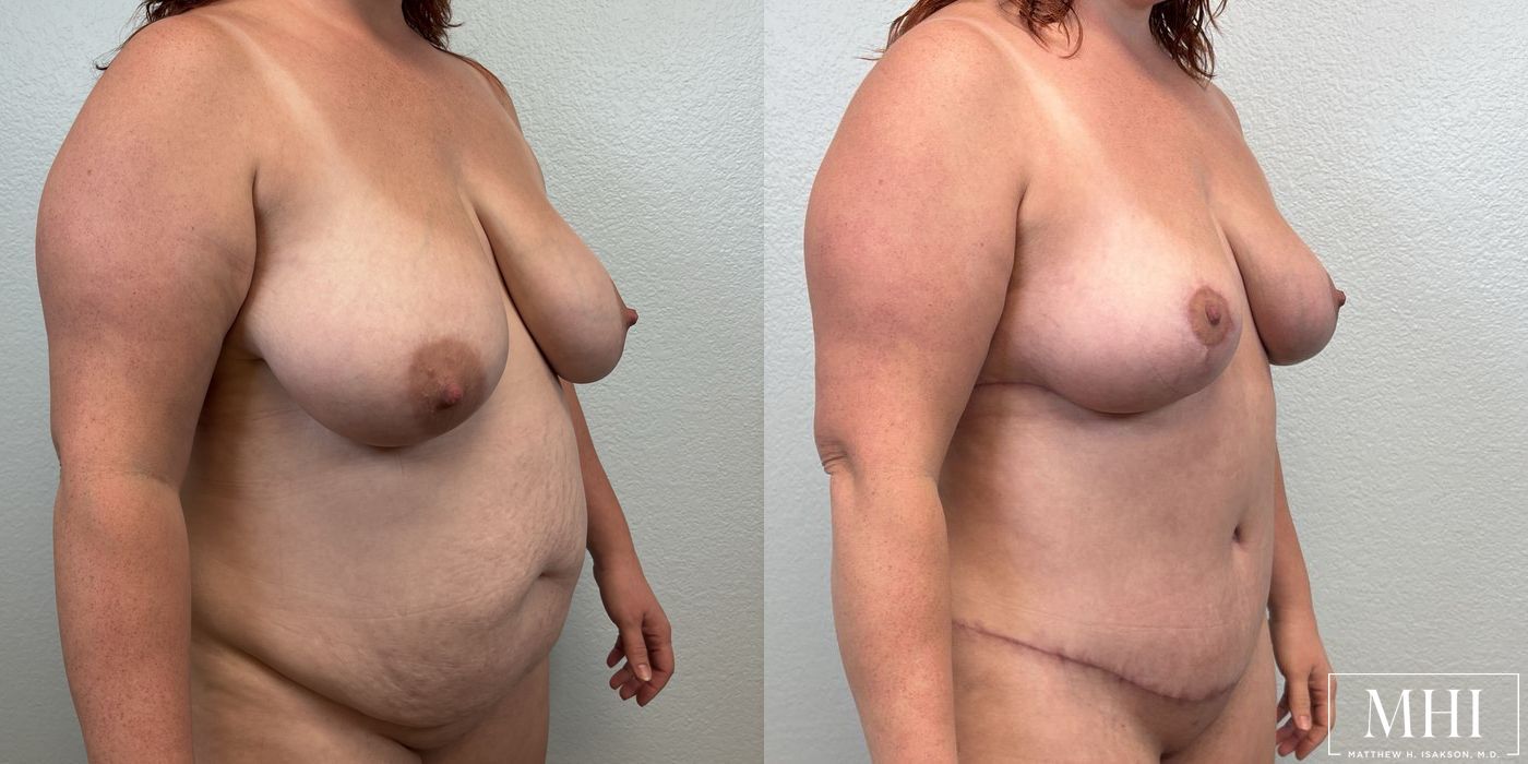 Breast Lift - Thumbnail 4