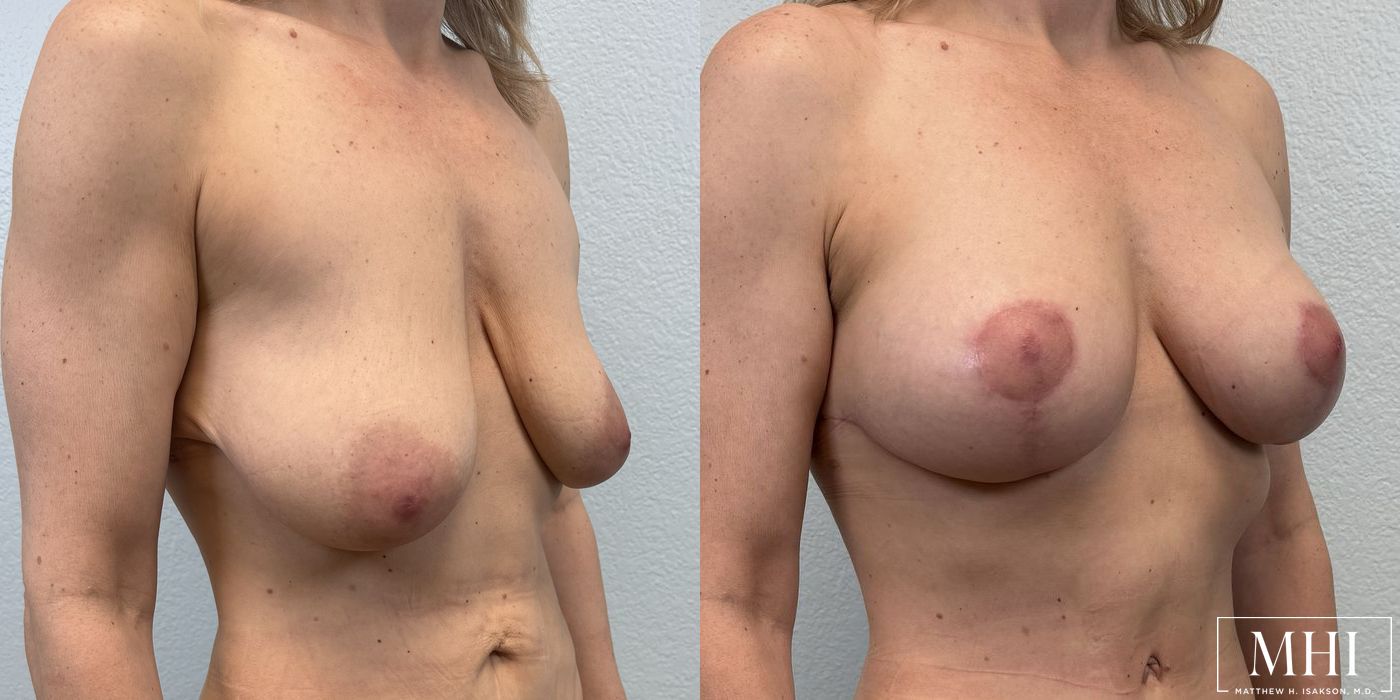 Breast Lift - Thumbnail 2