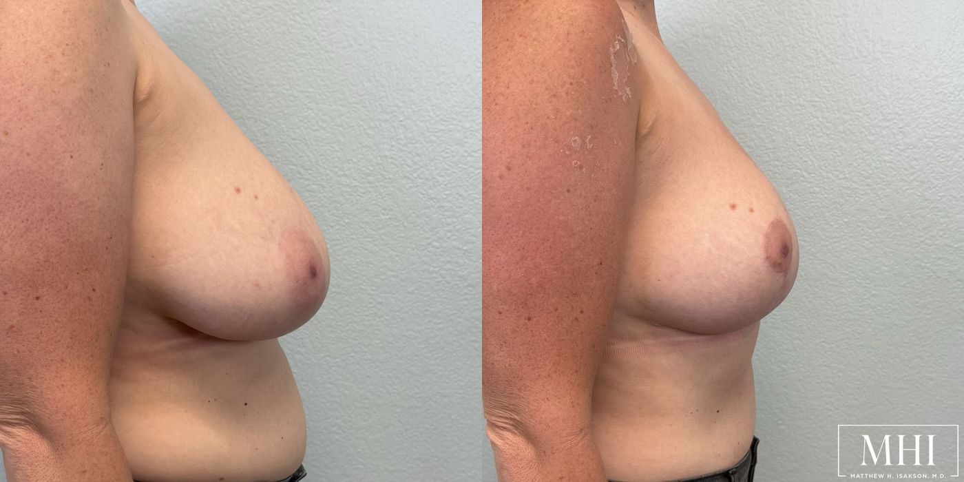 Breast Reduction - Thumbnail 4