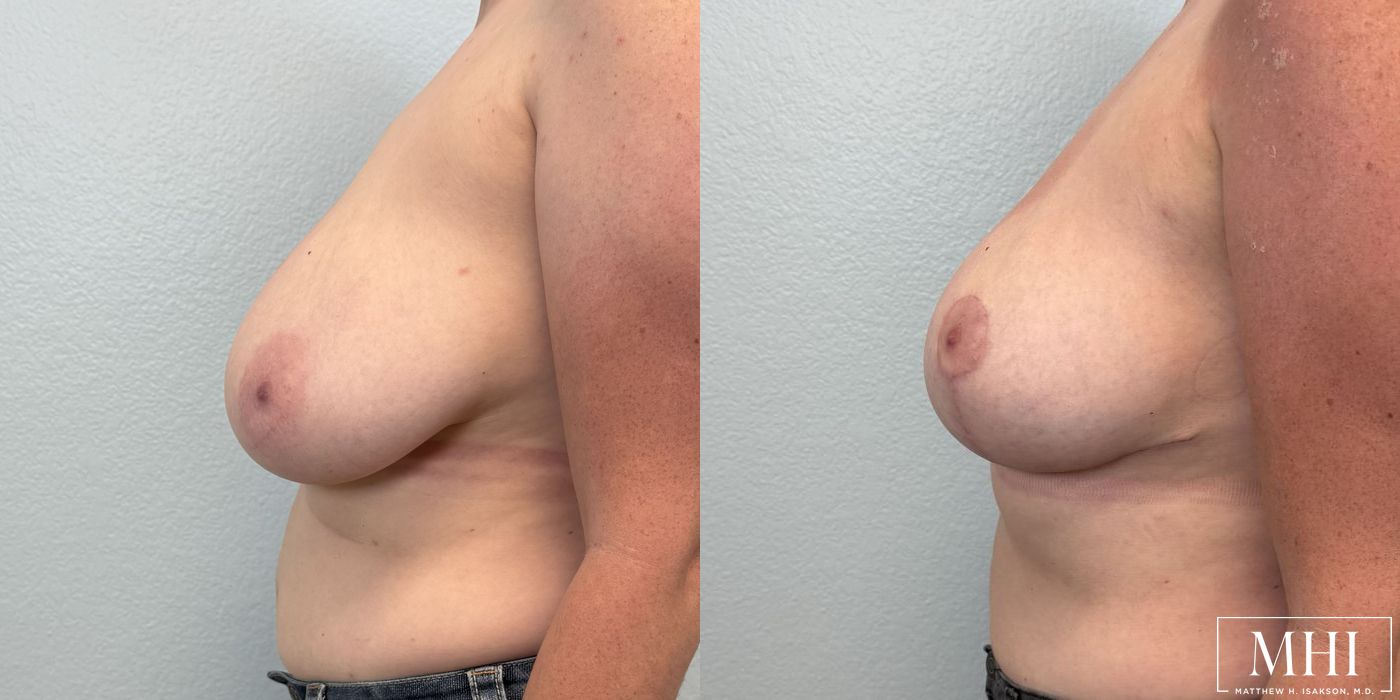 Breast Reduction - Thumbnail 2