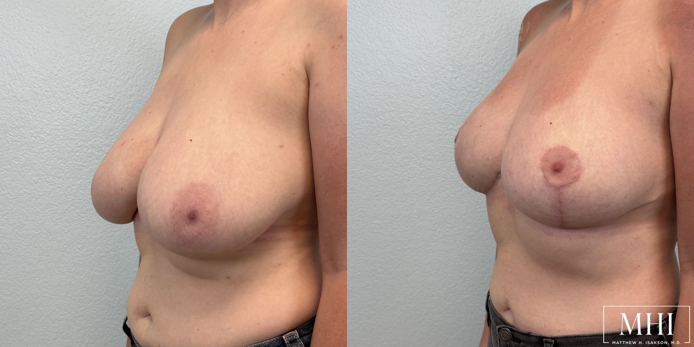 Breast Reduction - Case 12493