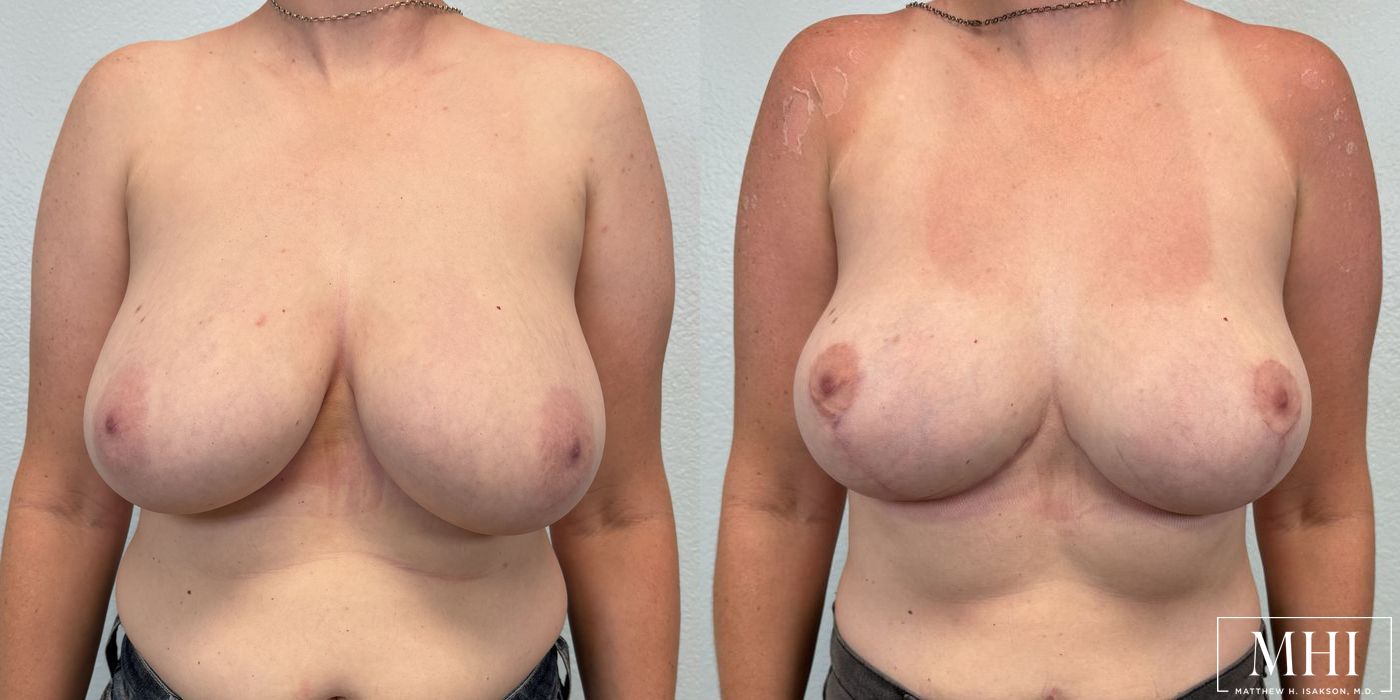 Breast Reduction - Thumbnail 5