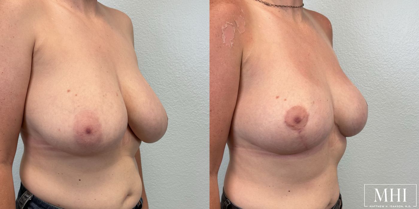 Breast Reduction - Thumbnail 3