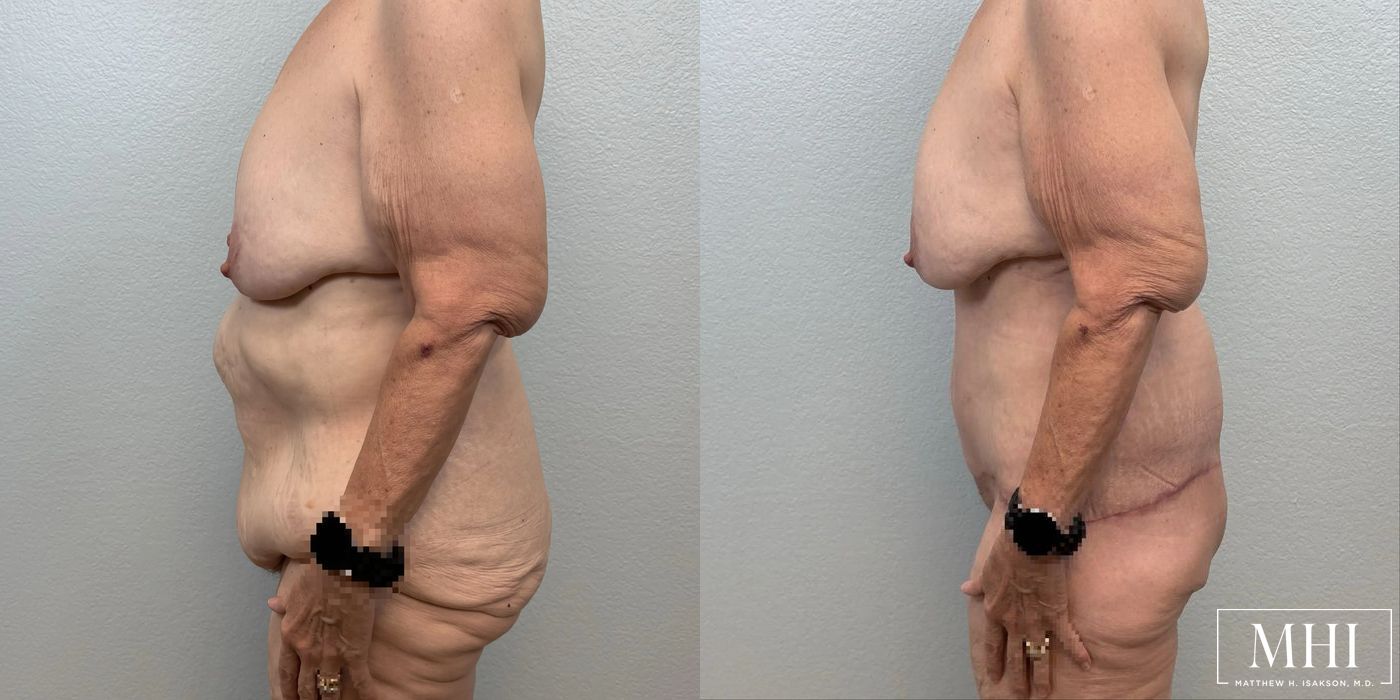 Lower Body Lift Belt Lipectomy - Thumbnail 2