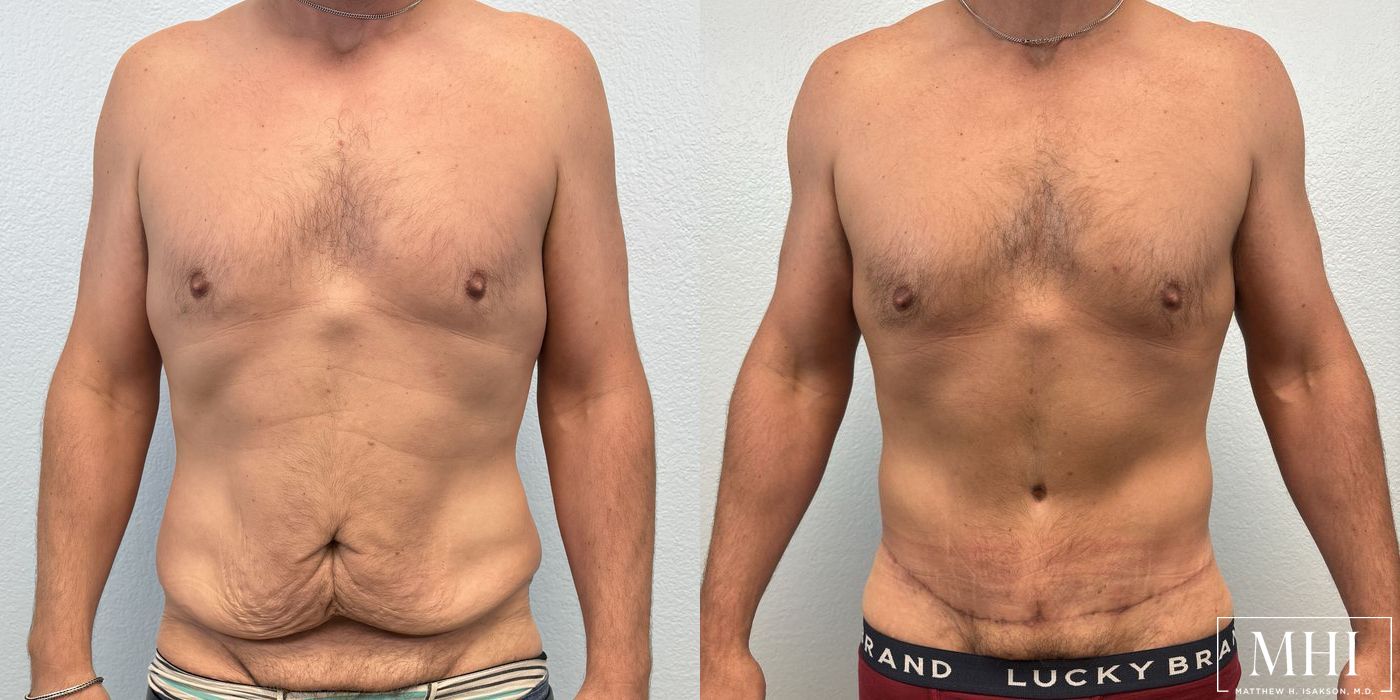 Lower Body Lift Belt Lipectomy - Case 12357