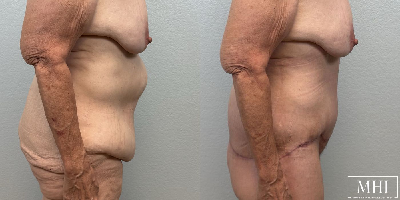 Lower Body Lift Belt Lipectomy - Thumbnail 5