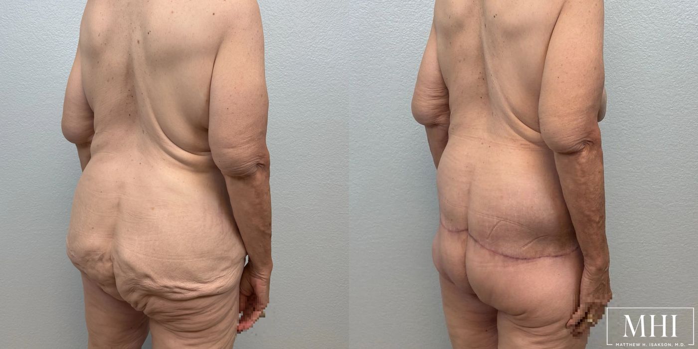 Lower Body Lift Belt Lipectomy - Thumbnail 6