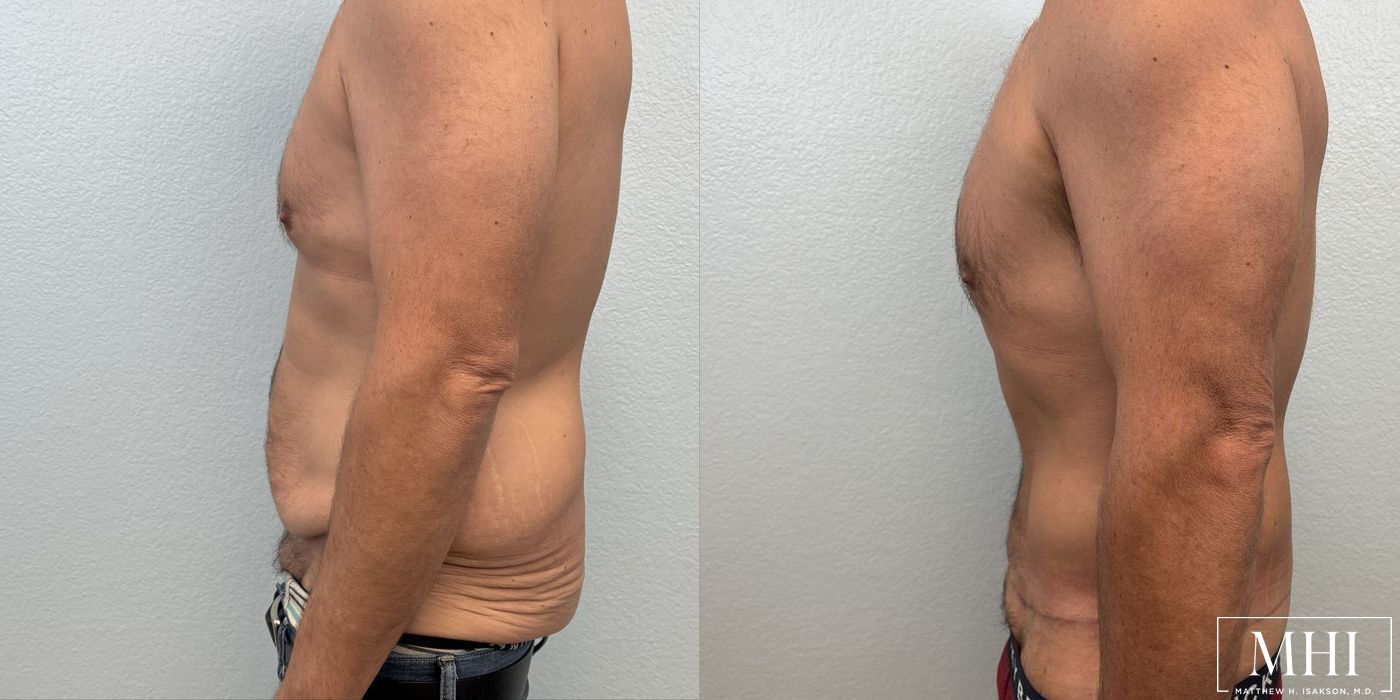 Lower Body Lift Belt Lipectomy - Thumbnail 3