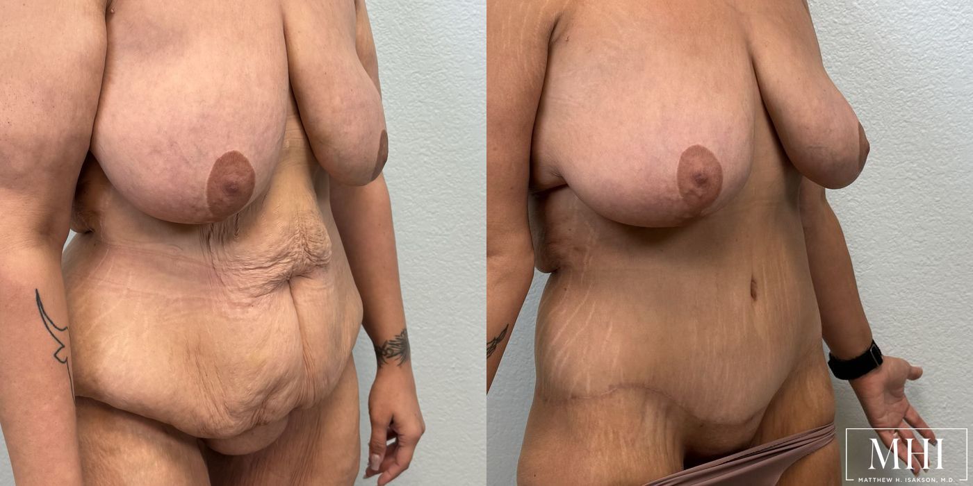 Lower Body Lift Belt Lipectomy - Thumbnail 4