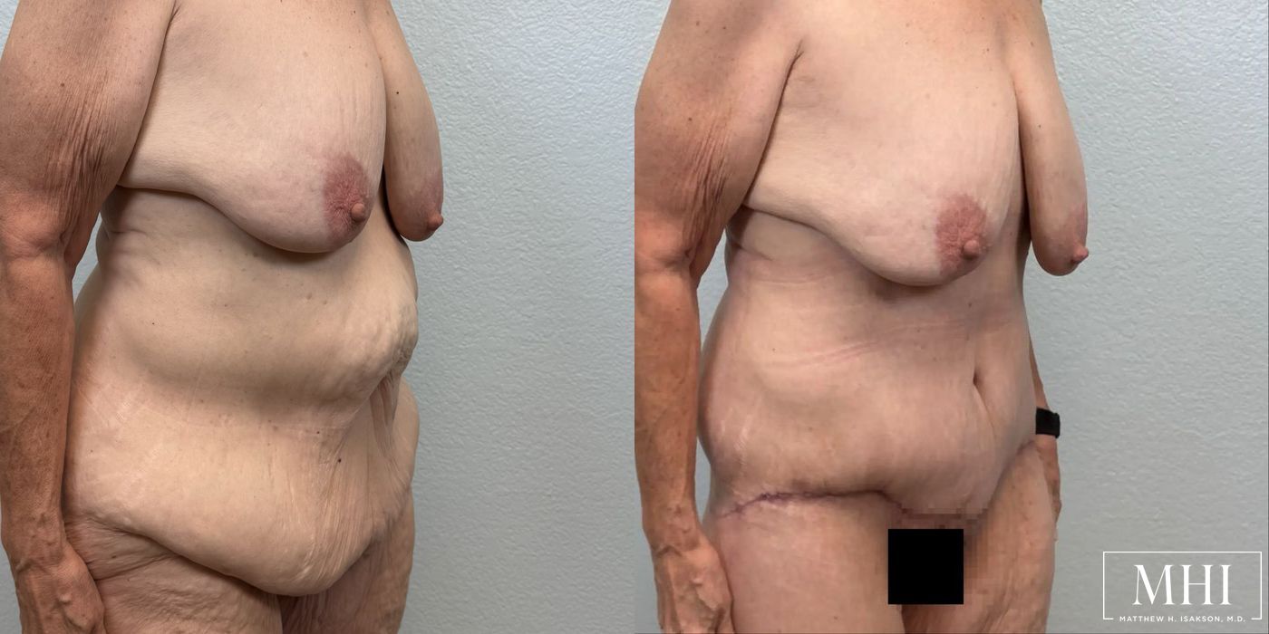 Lower Body Lift Belt Lipectomy - Thumbnail 4