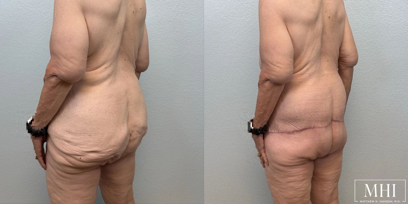 Lower Body Lift Belt Lipectomy - Thumbnail 7