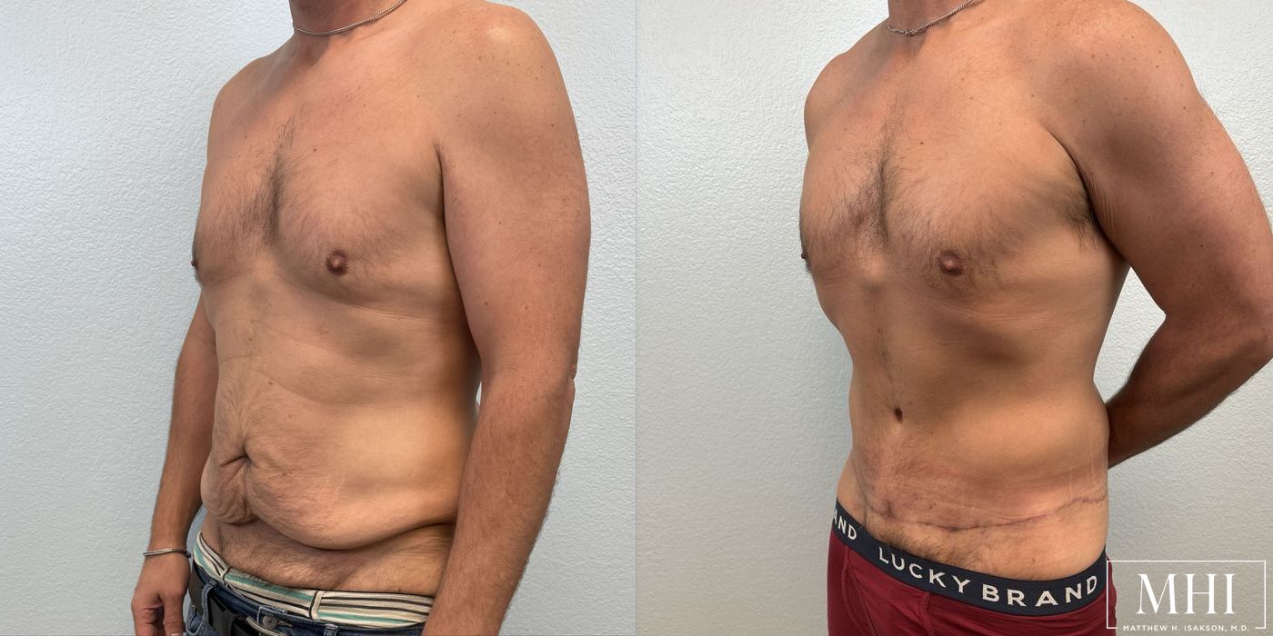 Lower Body Lift Belt Lipectomy - Thumbnail 2