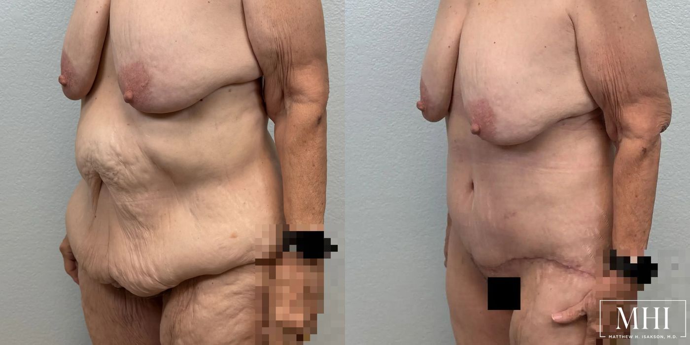 Lower Body Lift Belt Lipectomy - Case 12358