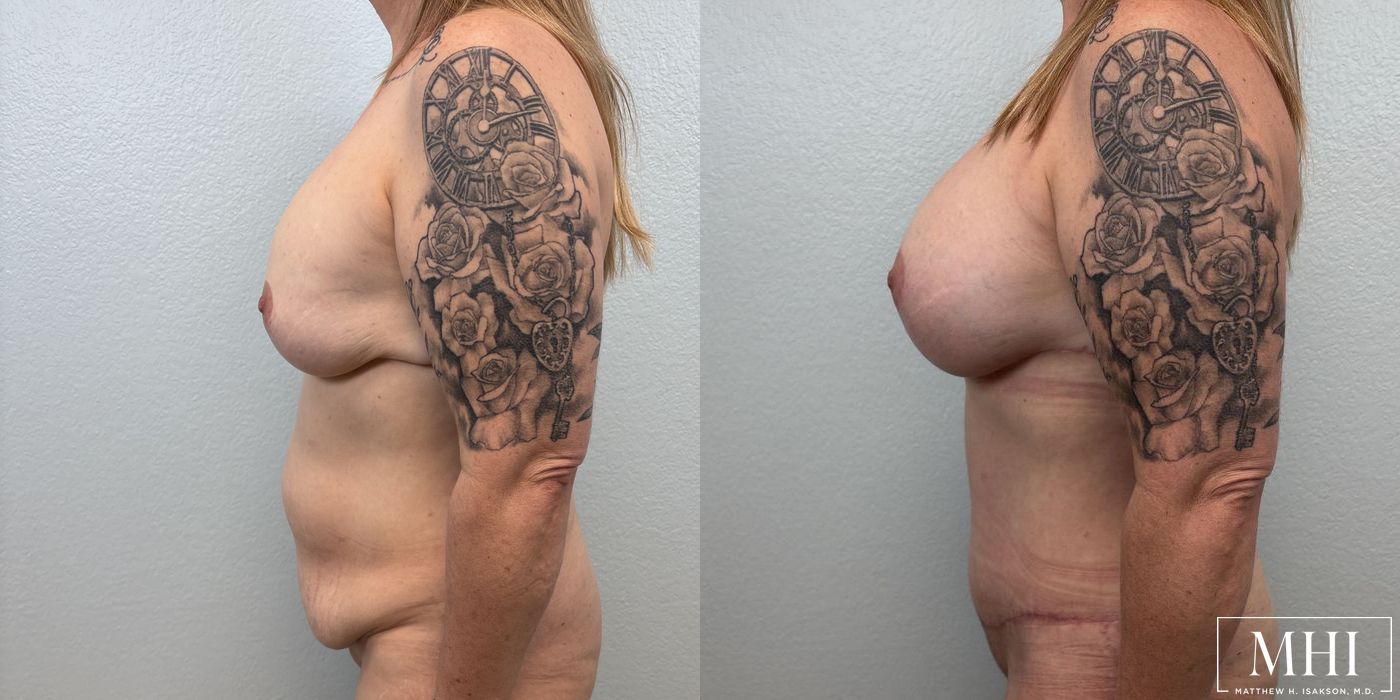 Breast Implant Capsulectomy, Total - Thumbnail 3