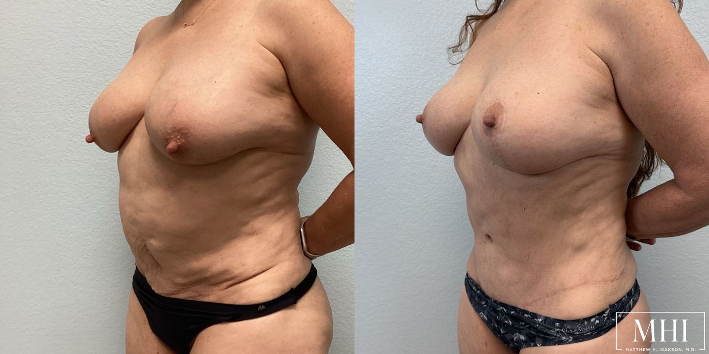 Mommy Makeover - Case 12080