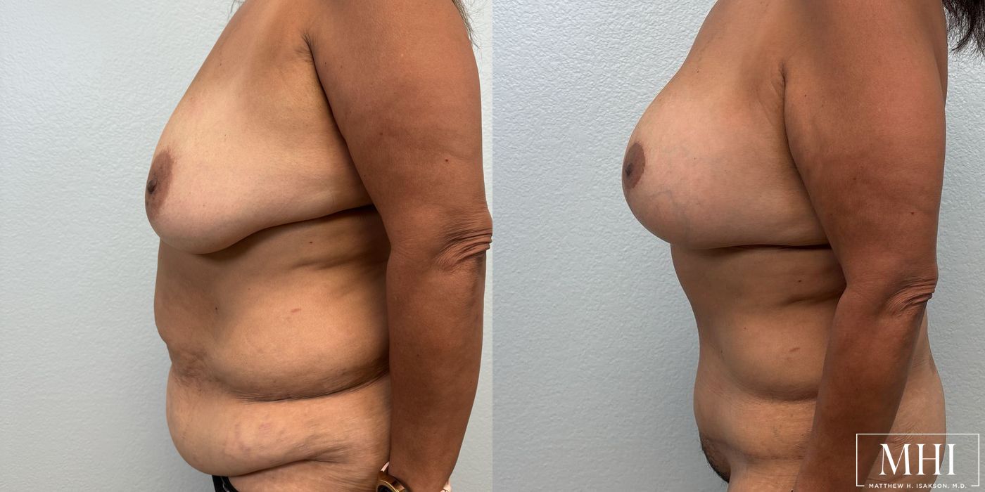 Mommy Makeover - Thumbnail 3