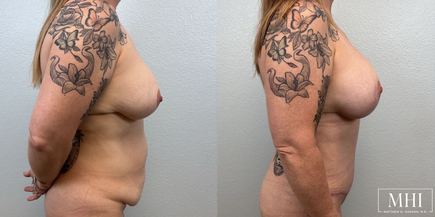 Breast Lift - Thumbnail 5