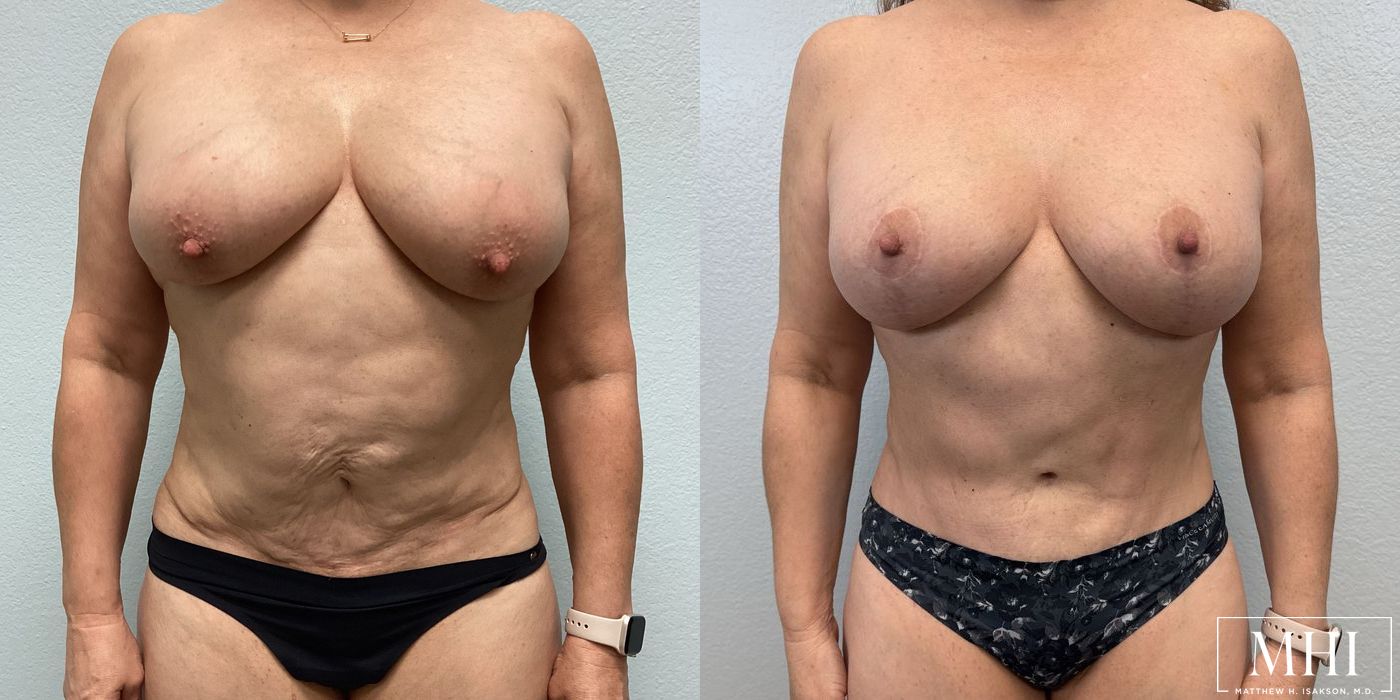 Mommy Makeover - Thumbnail 4