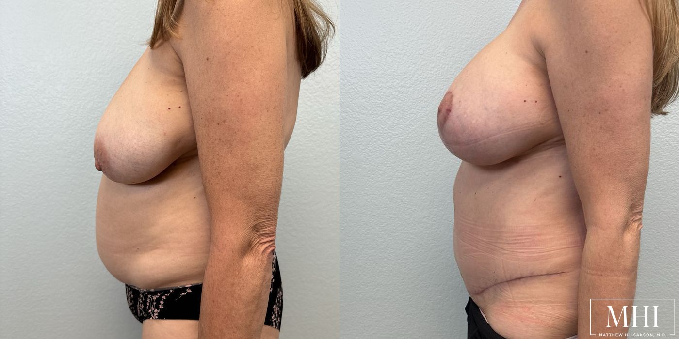 Breast Augmentation with Lift - Thumbnail 2