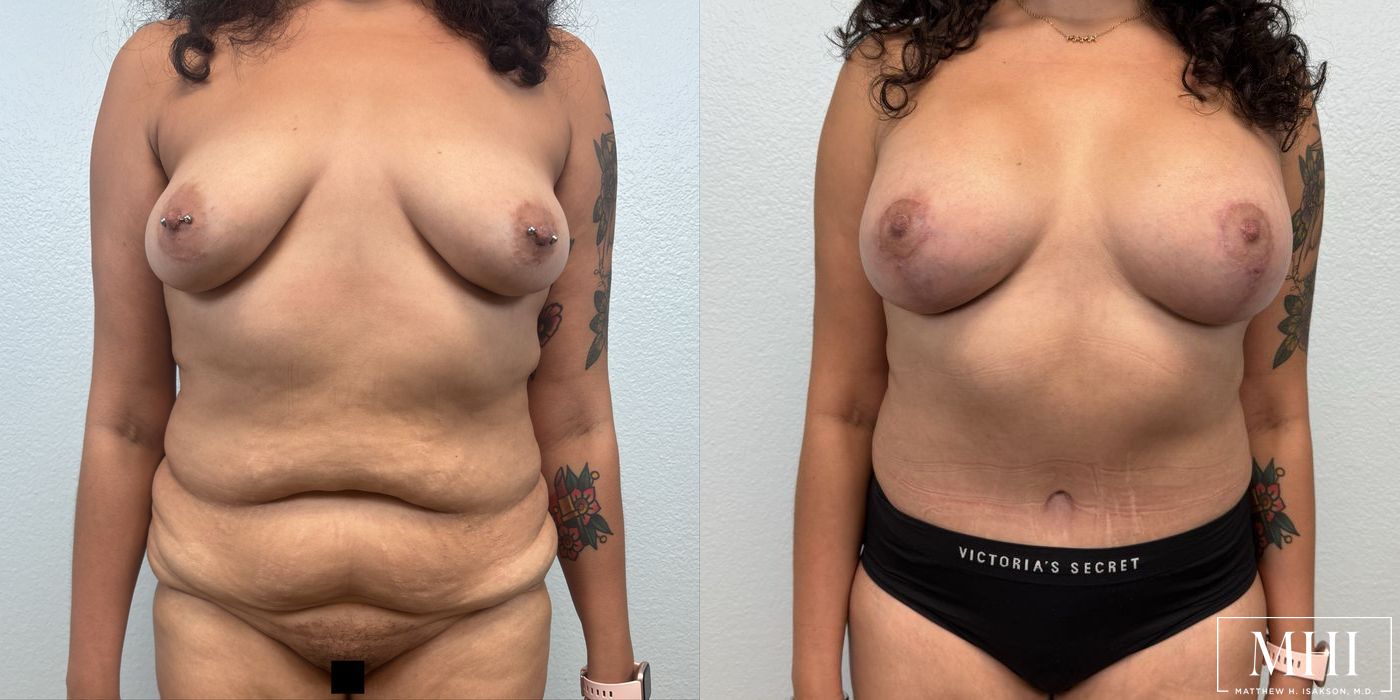 Breast Augmentation with Lift - Case 12092