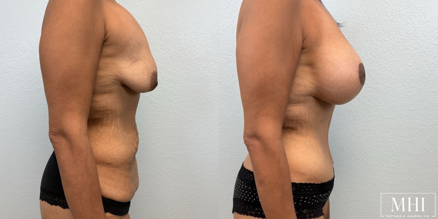 Breast Augmentation with Lift - Thumbnail 5