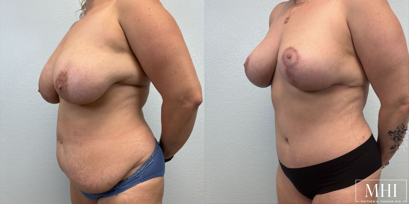 Breast Lift - Thumbnail 2