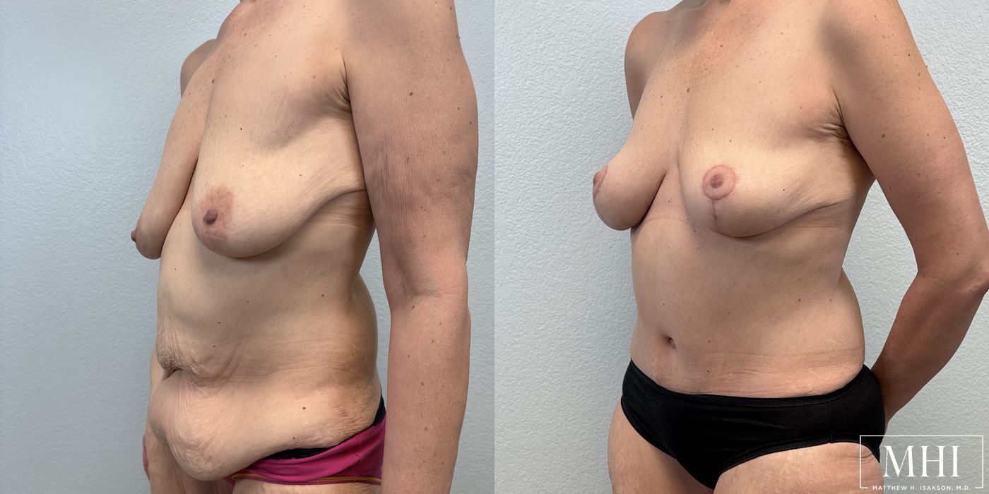 Breast Lift - Thumbnail 2