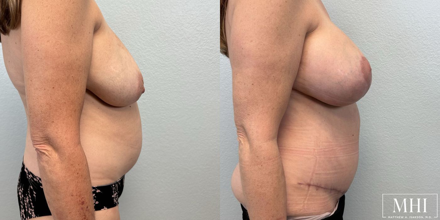 Breast Augmentation with Lift - Thumbnail 5