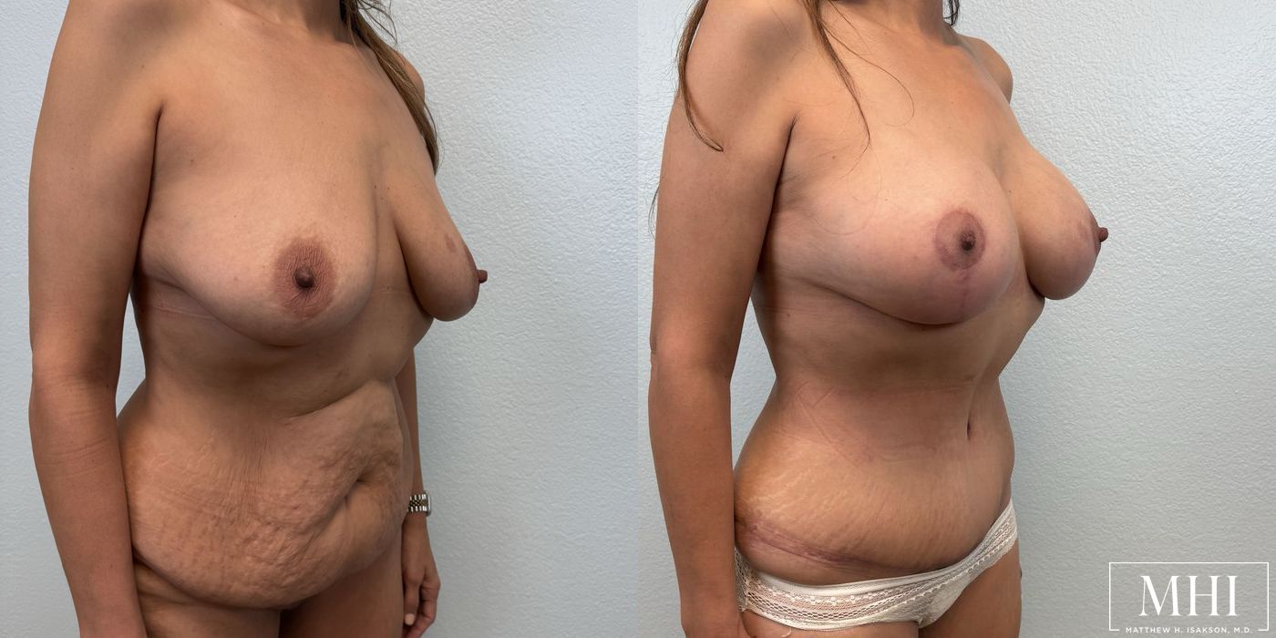 Breast Augmentation with Lift - Thumbnail 4