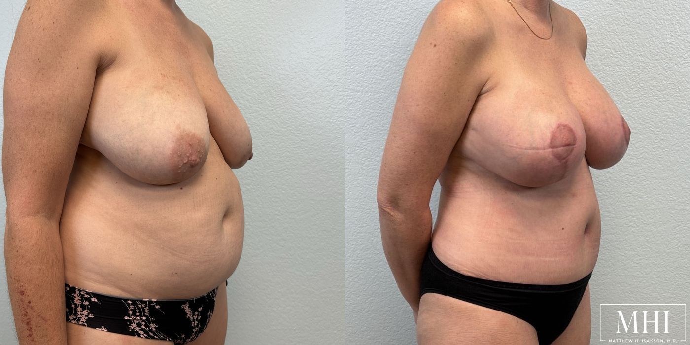 Breast Augmentation with Lift - Thumbnail 4