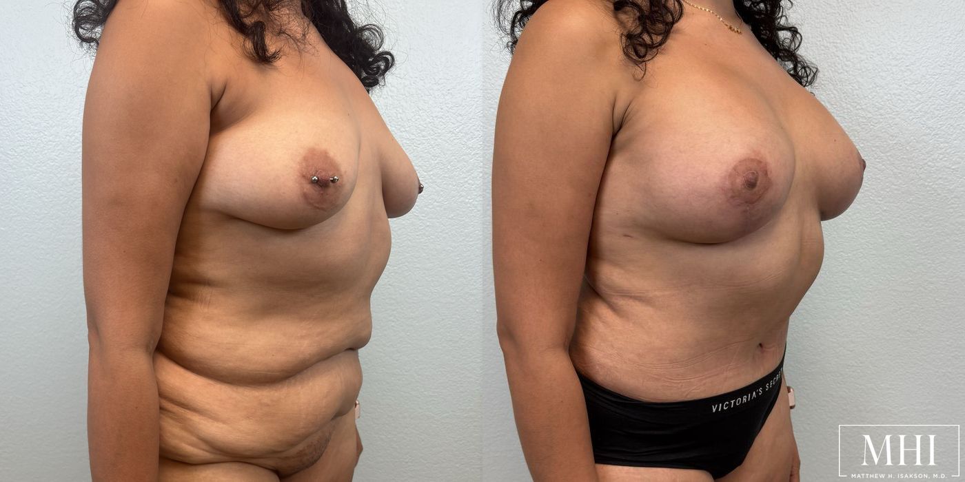 Breast Augmentation with Lift - Thumbnail 2