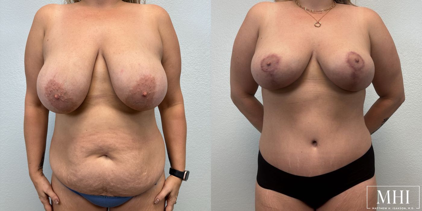 Breast Lift - Case 12087