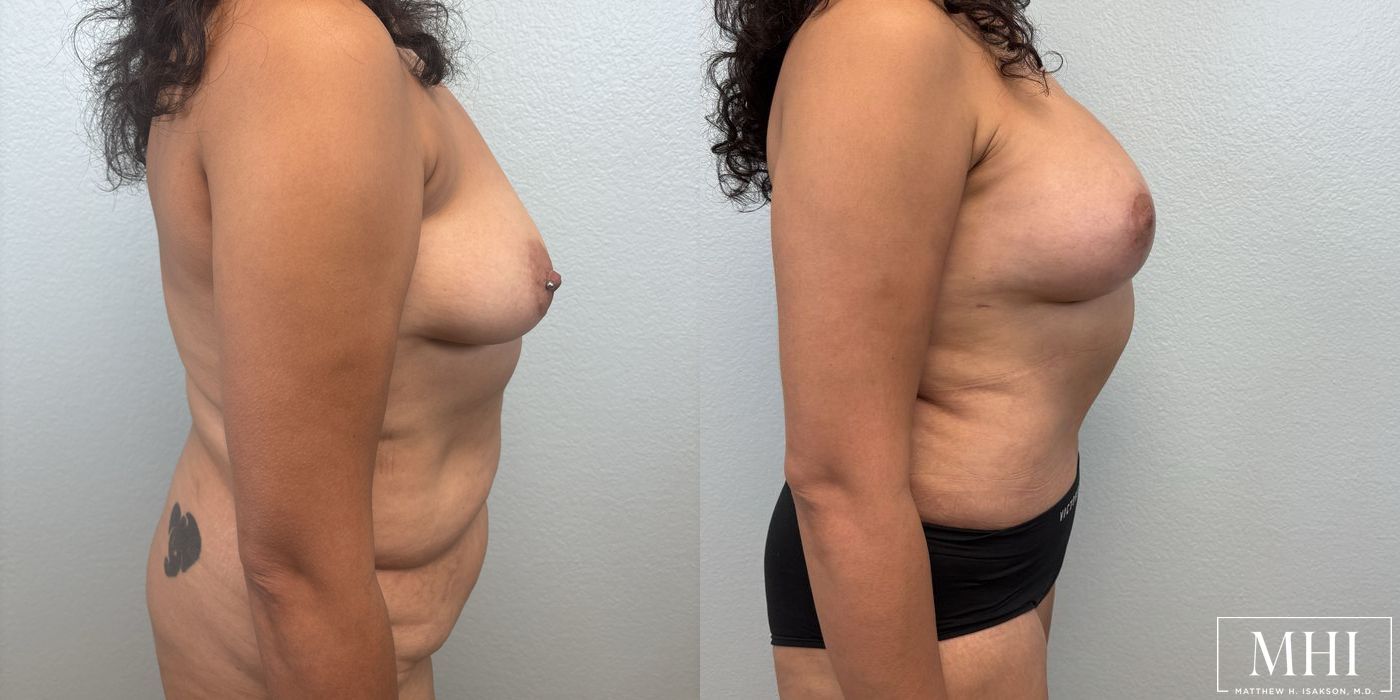 Breast Augmentation with Lift - Thumbnail 3