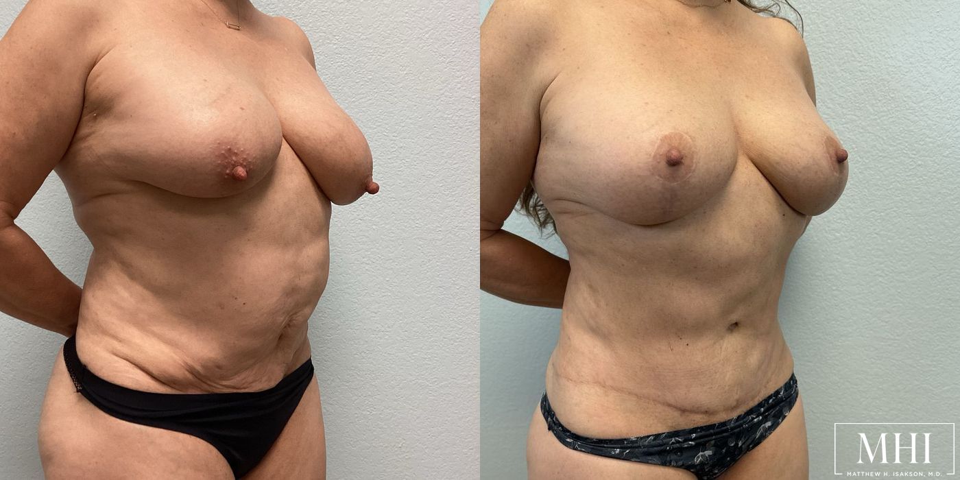 Mommy Makeover - Thumbnail 3