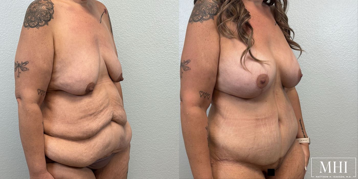 Breast Augmentation with Lift - Thumbnail 4