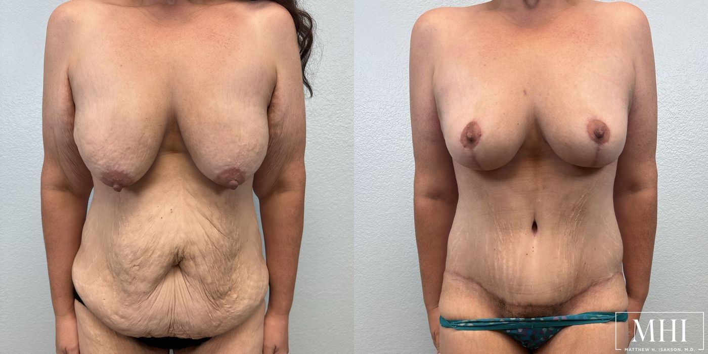 Breast Lift - Case 12143