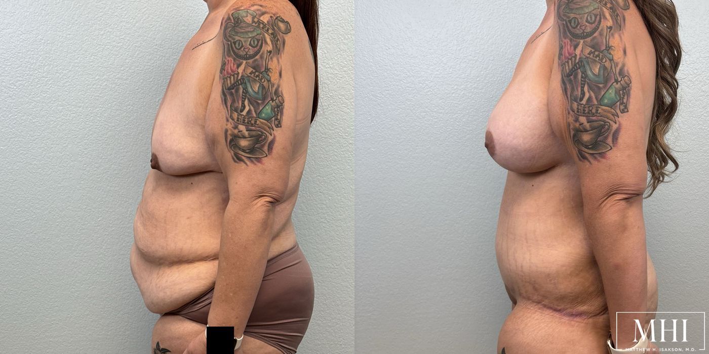 Breast Augmentation with Lift - Thumbnail 2