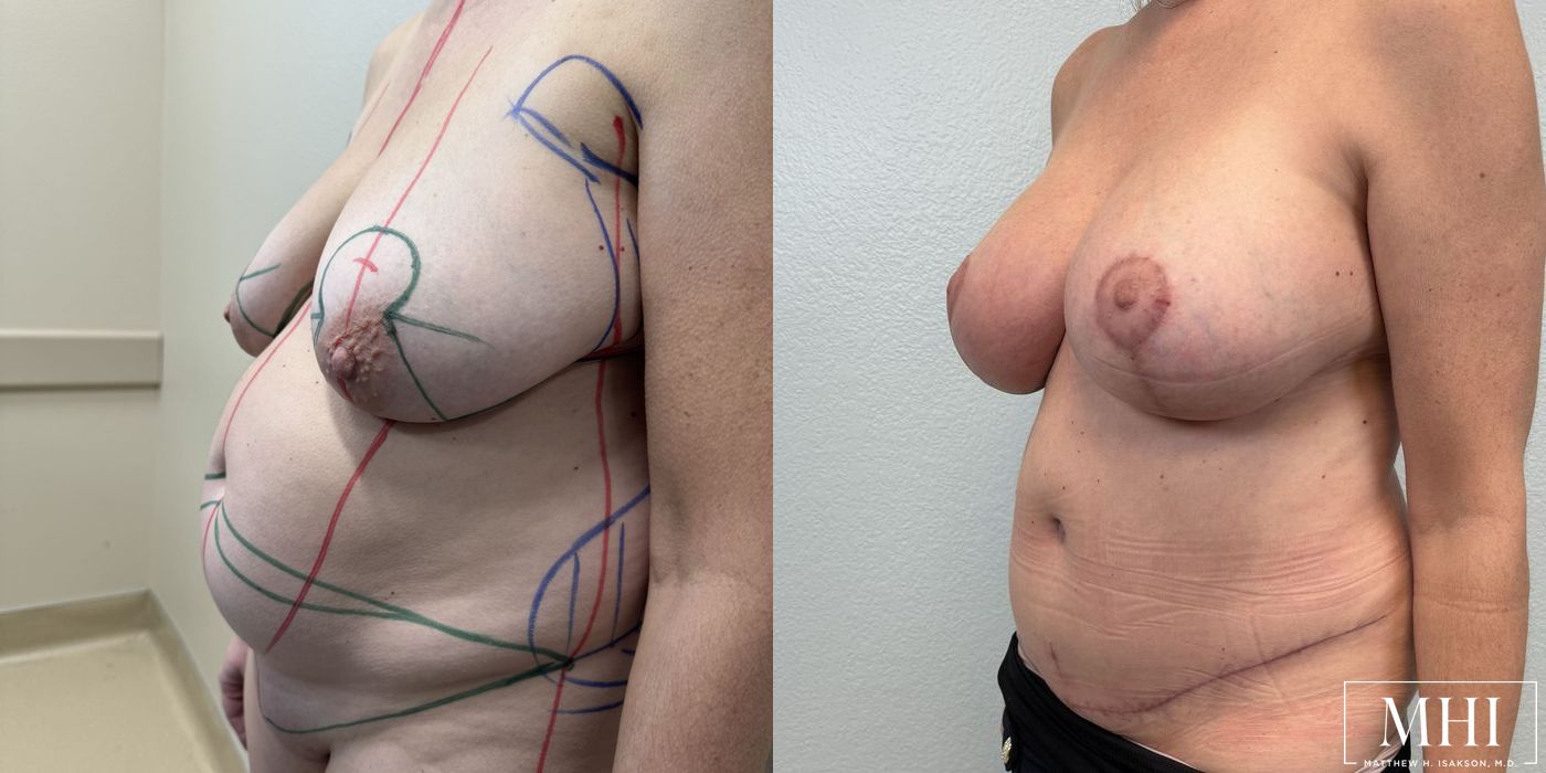Breast Augmentation with Lift - Case 12086