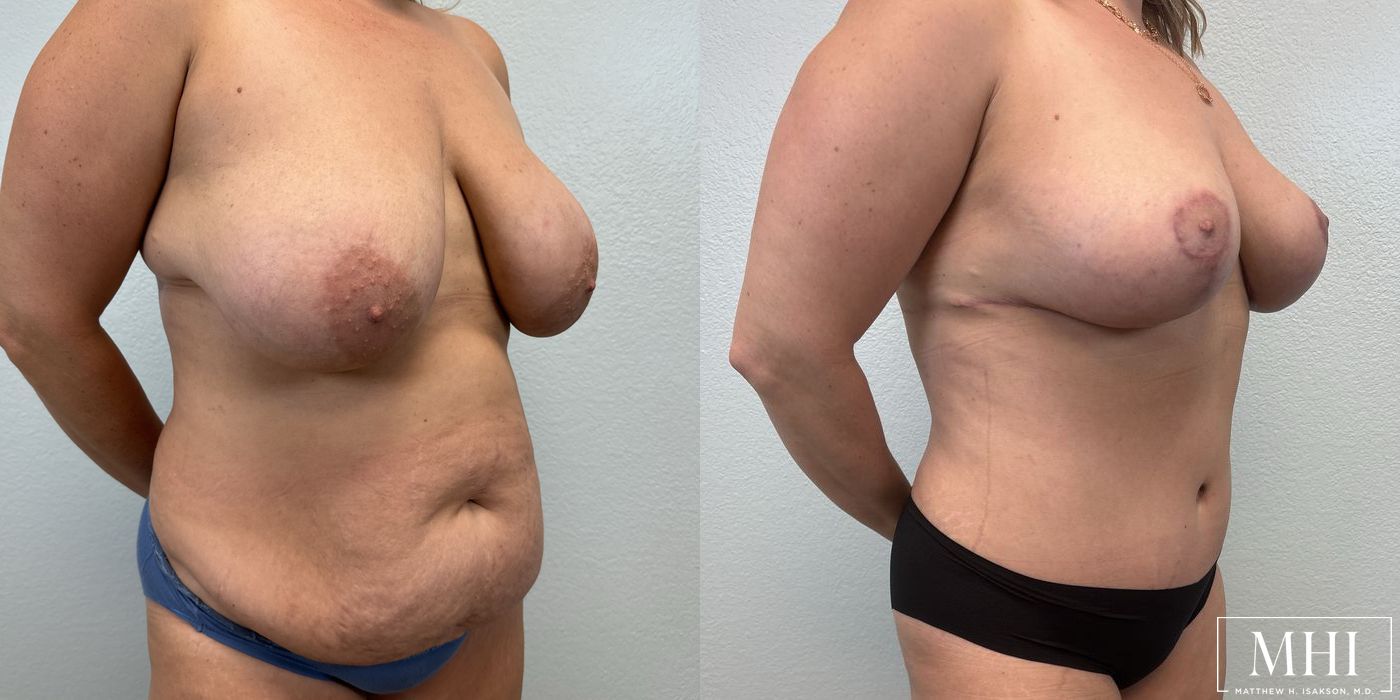 Breast Lift - Thumbnail 4