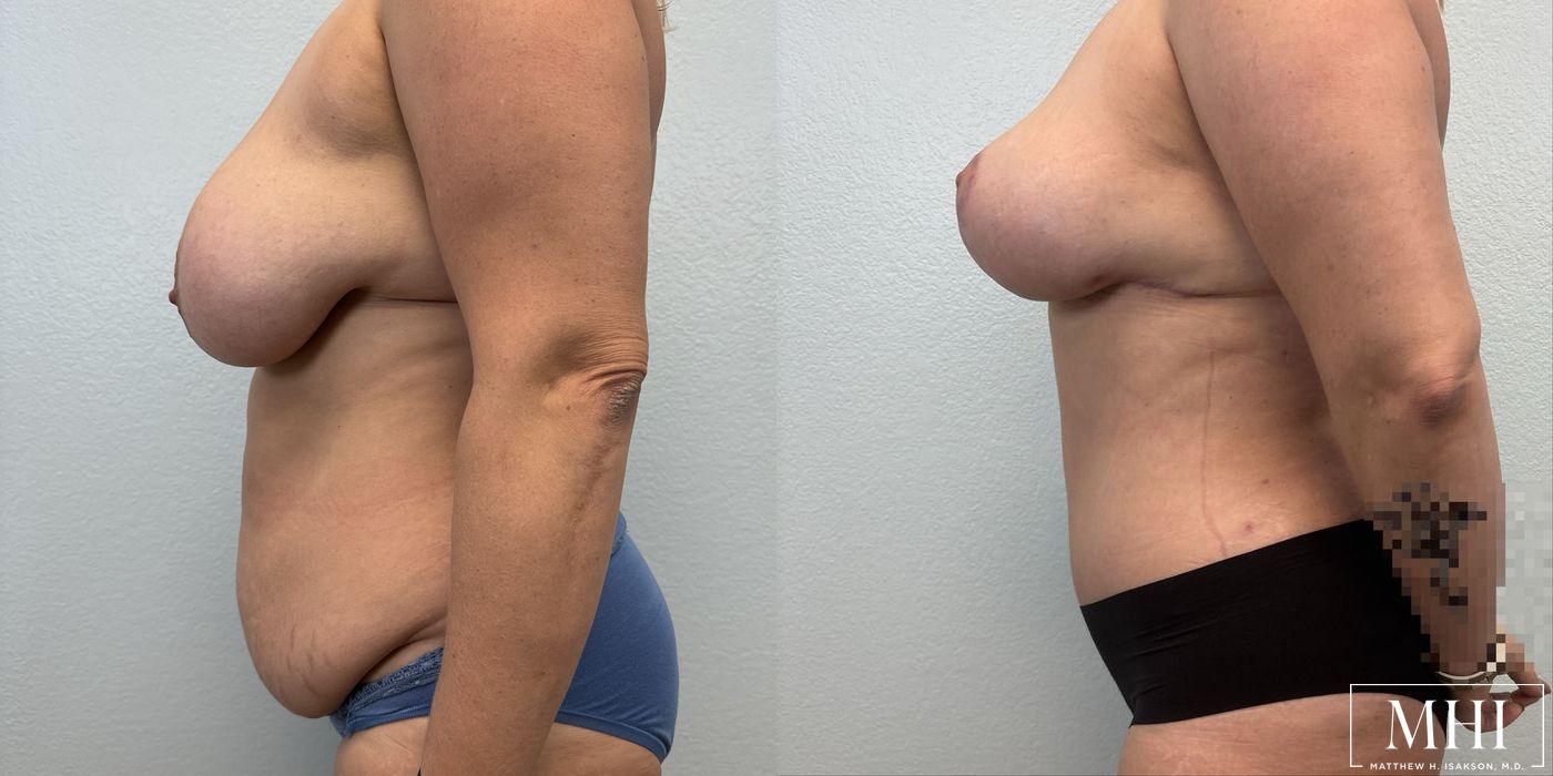 Breast Lift - Thumbnail 3