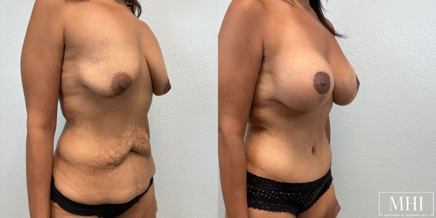 Breast Augmentation with Lift - Thumbnail 4