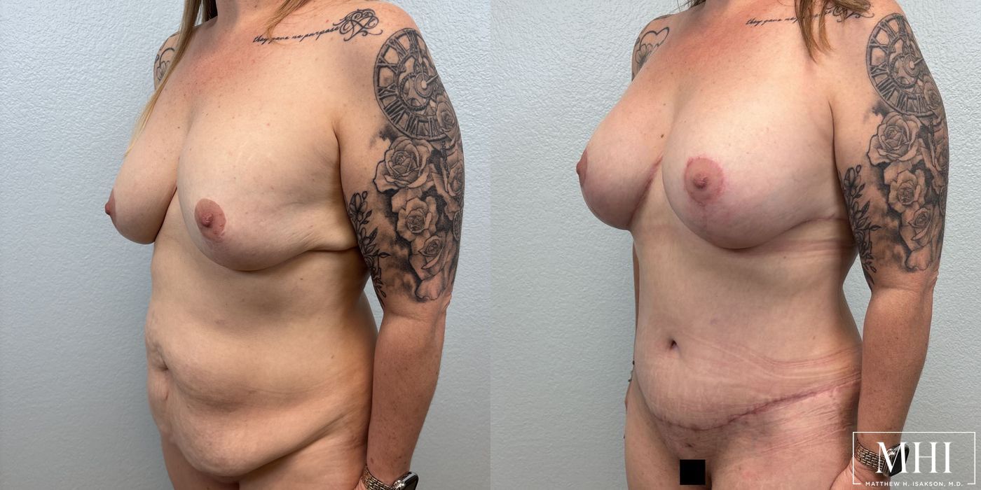 Breast Implant Capsulectomy, Total - Thumbnail 2