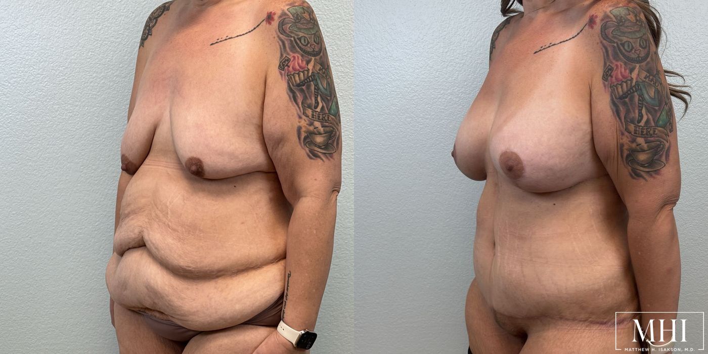 Breast Augmentation with Lift - Case 12129