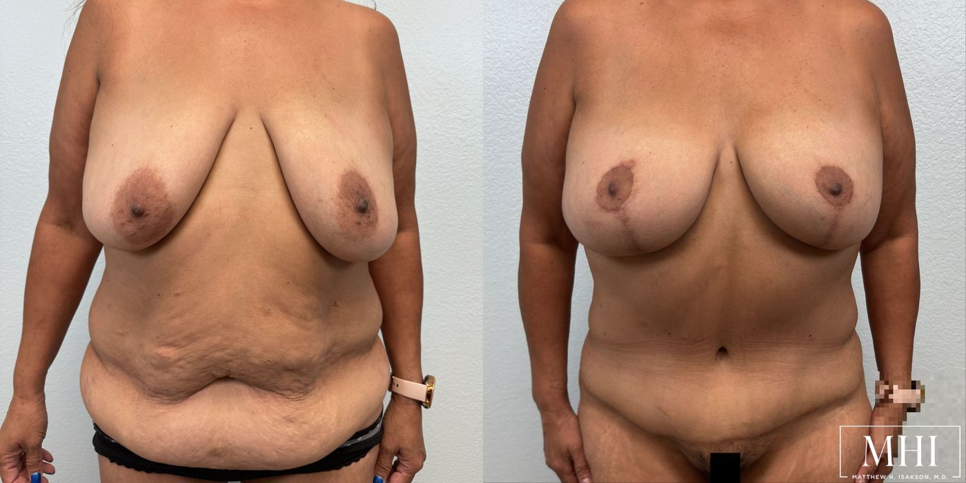 Mommy Makeover - Case 12085