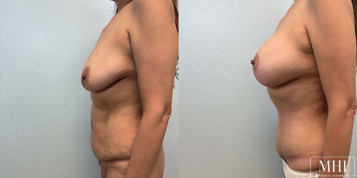 Breast Augmentation with Lift - Thumbnail 3