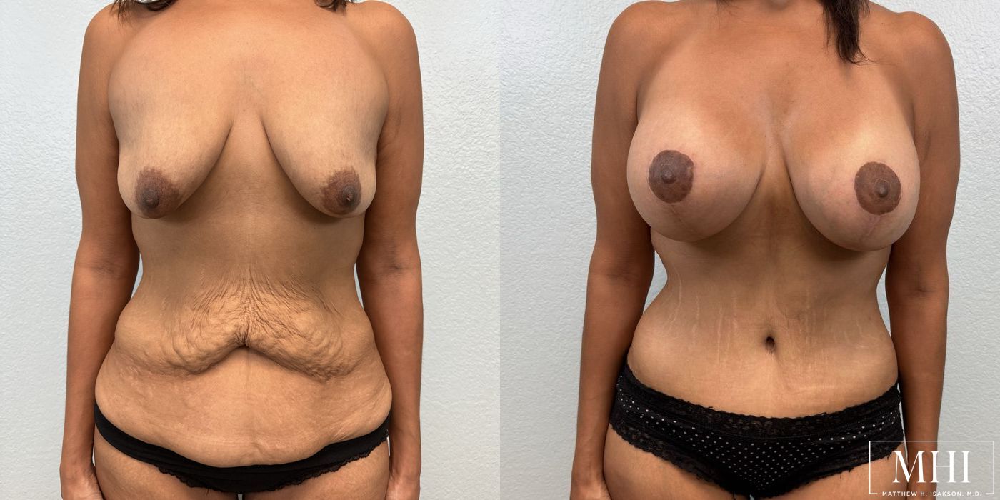 Breast Augmentation with Lift - Case 12088