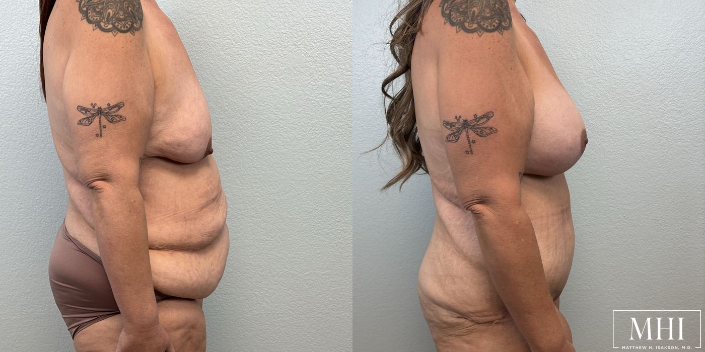 Breast Augmentation with Lift - Thumbnail 5